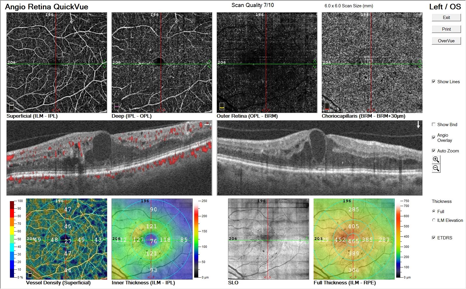 Referto Angio-OCT di edema maculare diabetico: plessi vascolari superficiale e profondo, B-scan con cisti intraretiniche e ispessimento maculare, mappe di densità vascolare e spessore retinico ETDRS