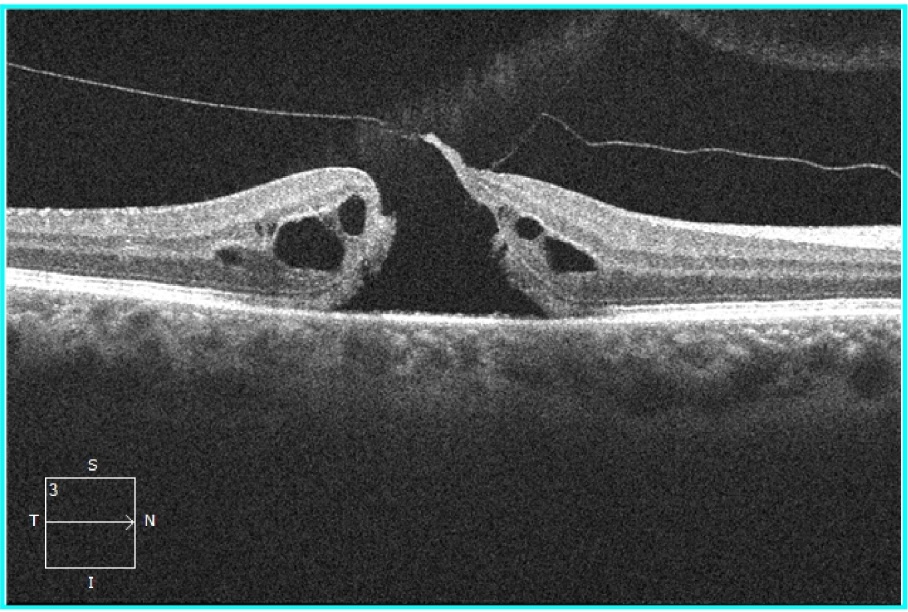 Scansione OCT di un foro maculare a tutto spessore: interruzione completa degli strati retinici in fovea con cisti intraretiniche ai margini e iperriflettività ialoidea residua