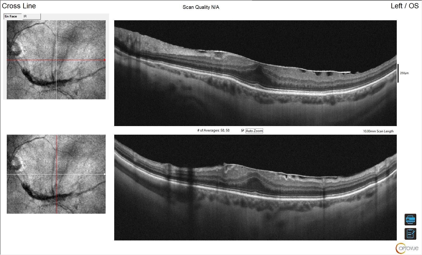 Scansione OCT Cross Line di una macula con membrana epiretinica: superficie retinica corrugata e depressione foveale ridotta