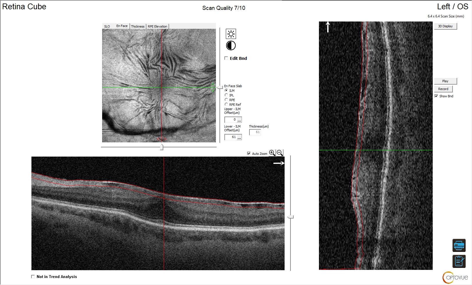 OCT Retina Cube en face della stessa macula: le pieghe retiniche irradiano dal centro della membrana epiretinica