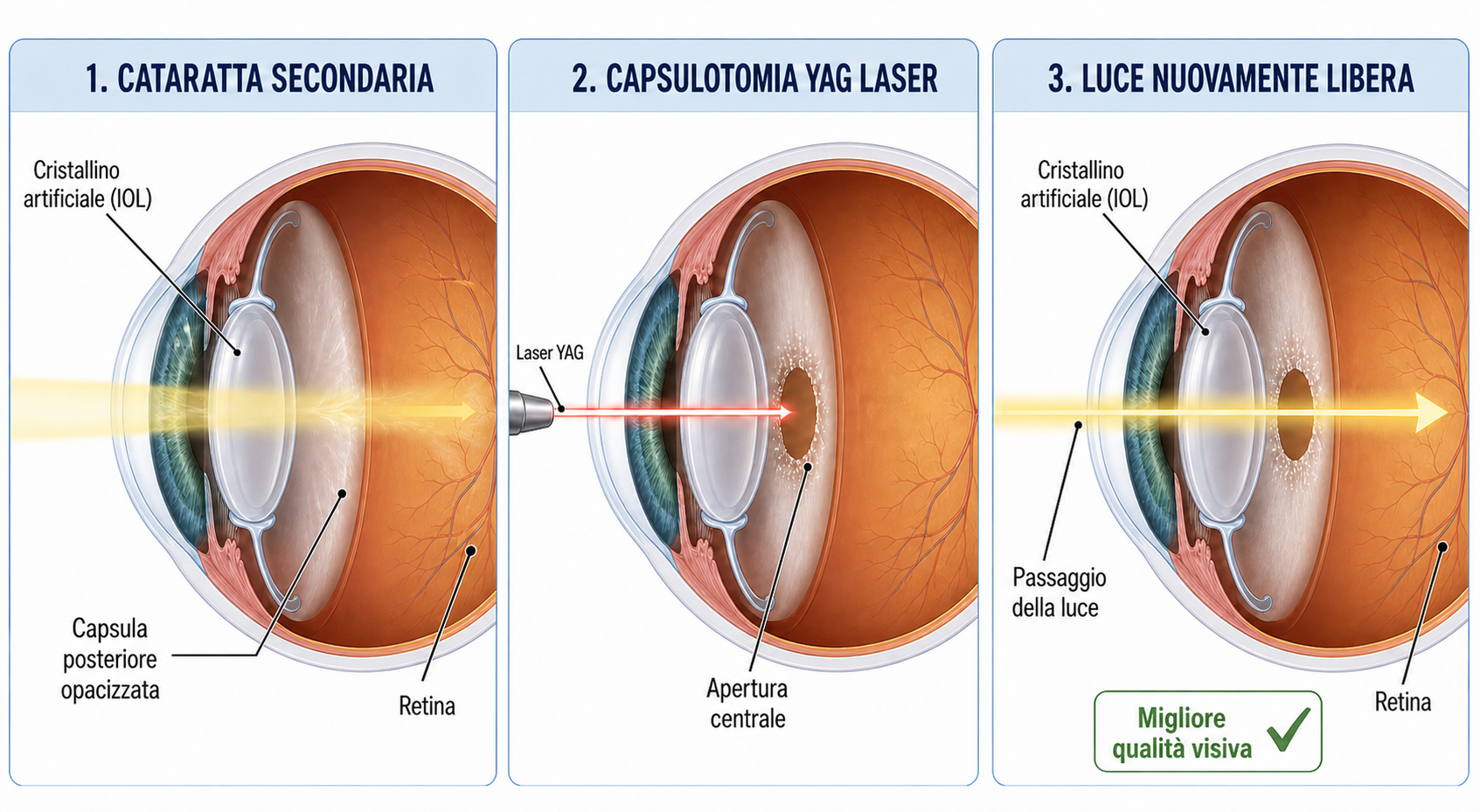 Schema in tre fasi della capsulotomia YAG: capsula posteriore opacizzata, apertura con laser YAG, ripristino del passaggio della luce